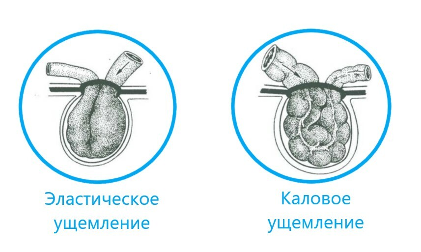 Ущемление пупочной грыжи симптомы