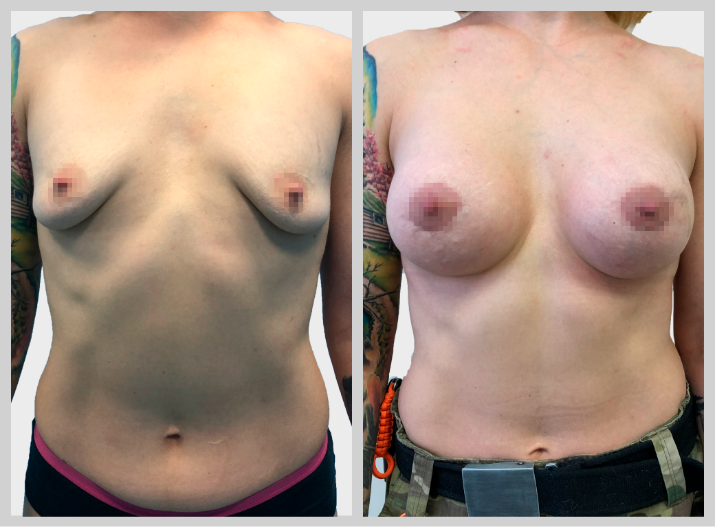 маммопластика увеличение груди импланты