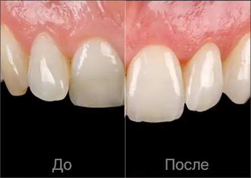 Отбеливание и восстановление