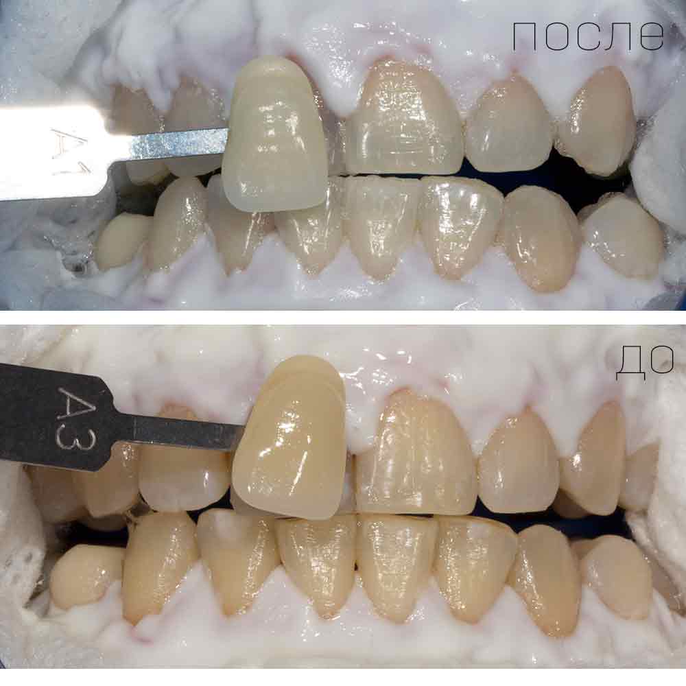 РУМЕНТИ: Отбеливание зубов 