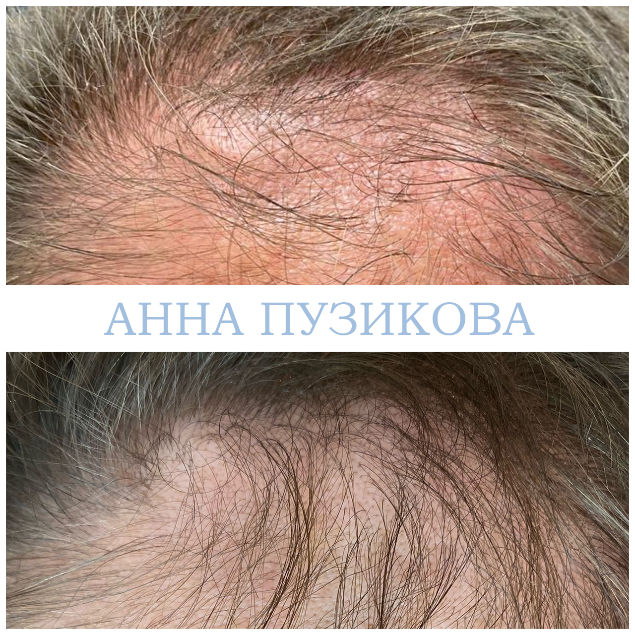 Результат лечения выпадения волос: повышение густоты, укрепление корней и улучшение состояния кожи головы — Прадус СПб.