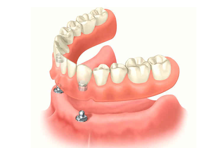 Съемные зубные протезы: виды и особенности, показания к установке
