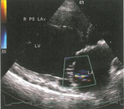 Слабовыраженная митральная регургитация