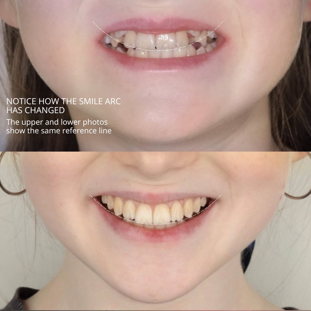 After treatment view showing corrected occlusion, alignment, and smile arc — photo 3 of 3