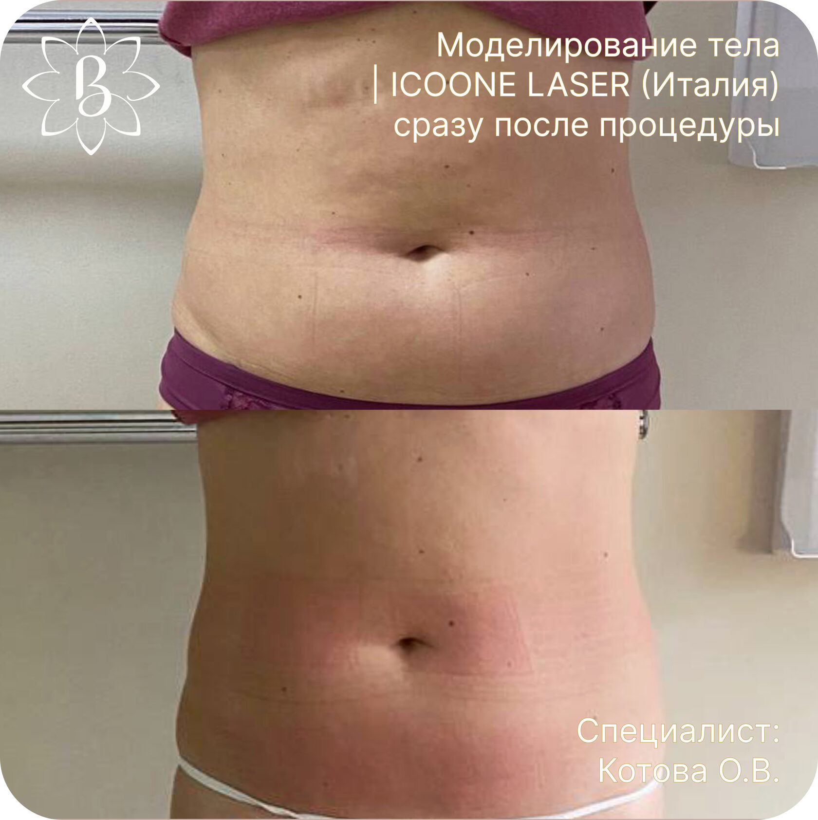 Диодная лазерная эпиляция СПб