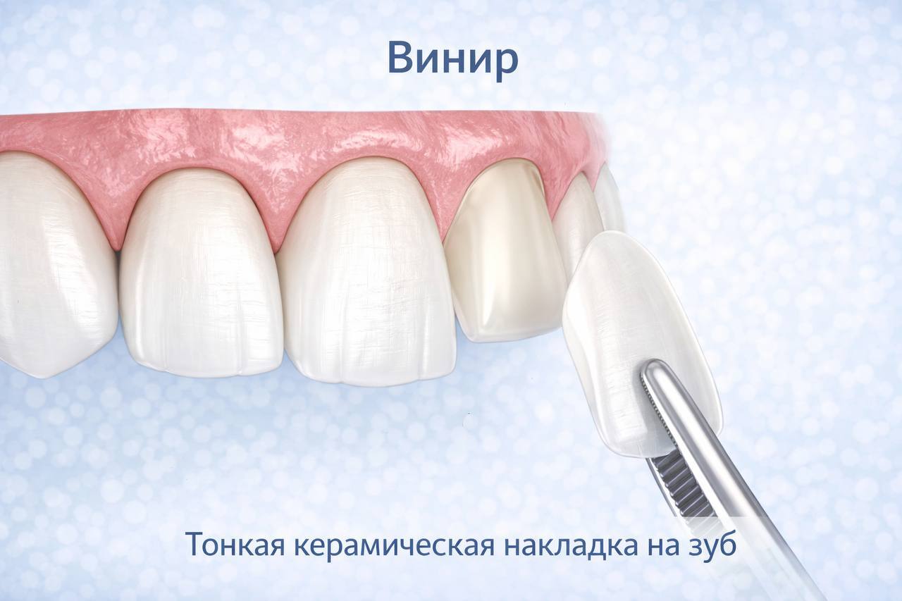 Виниры  на зубы в стоматологии «ЗУБ» Жуковский