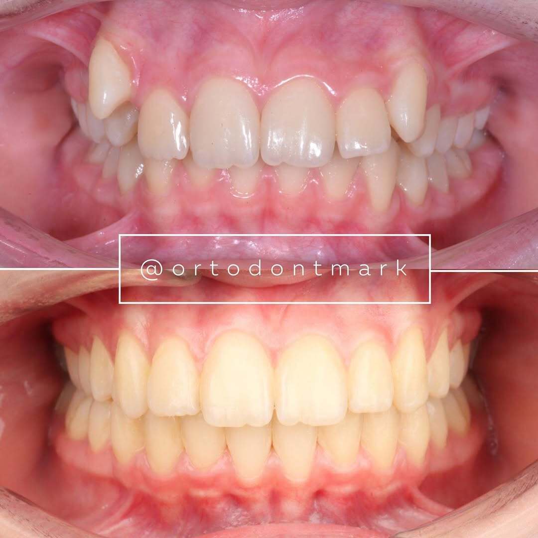 After treatment: wide, open, and symmetrical smile with resolved crowding — photo 2 of 2