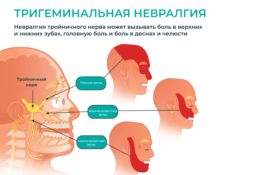 Боли при невралгии