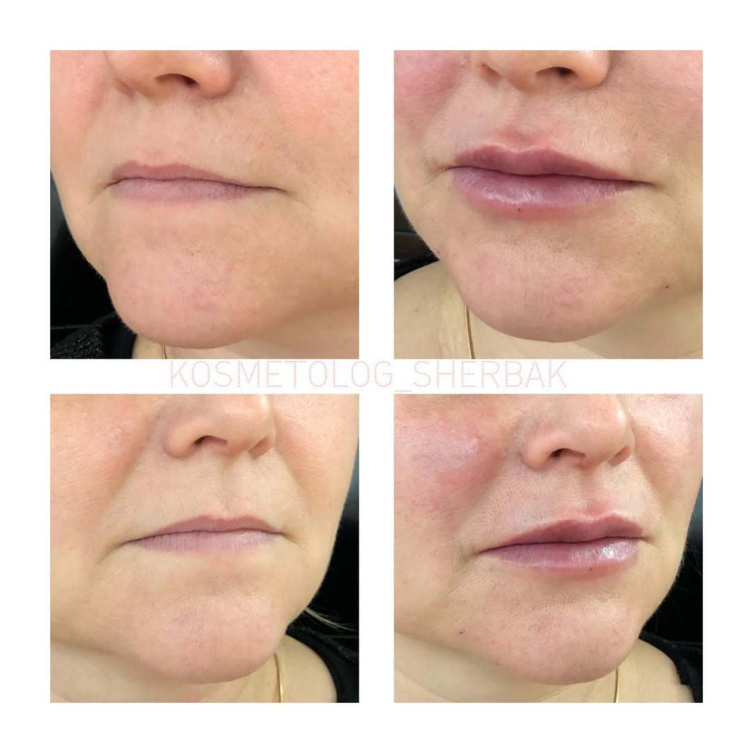 До и после контурной пластики губ. Увеличение объёма без утяжеления. PradusCOSMO, Васильевский остров