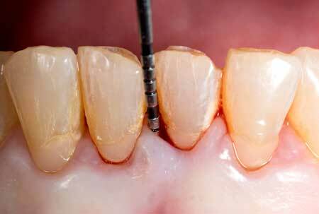 Какие зубы могут шататься?