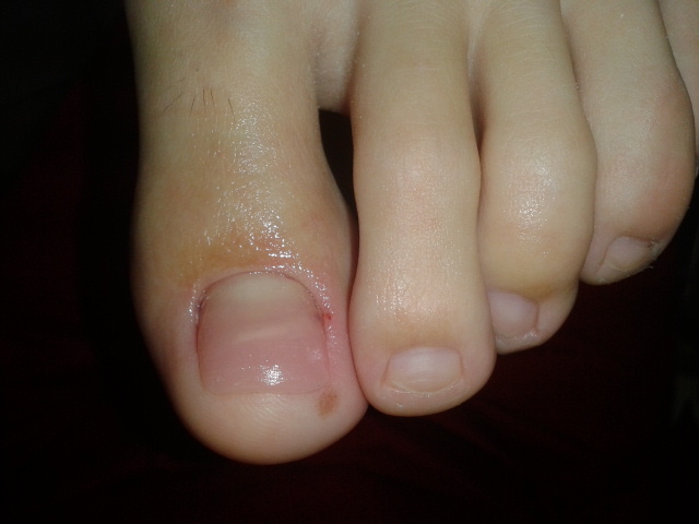 ЛЕЧЕНИЕ ВРОСШЕГО НОГТЯ БЕЗ ОПЕРАЦИИ В МОСКВЕ - ОРТОНИКСИЯ