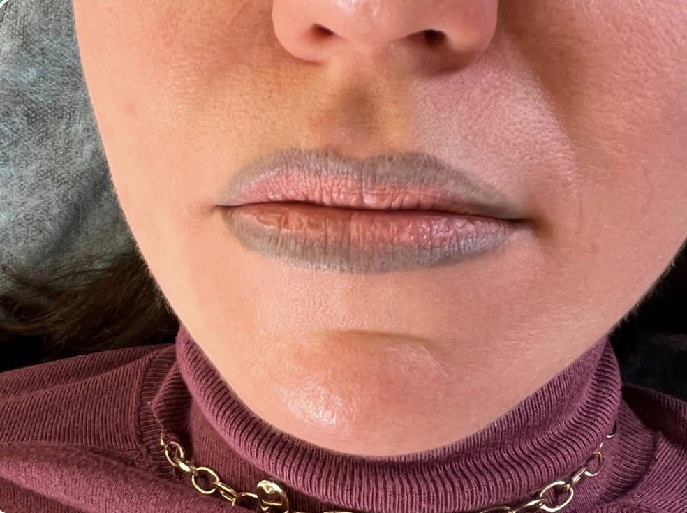 Удаление перманентного макияжа губ лазером. Ошибки. - zero-pmu.ru