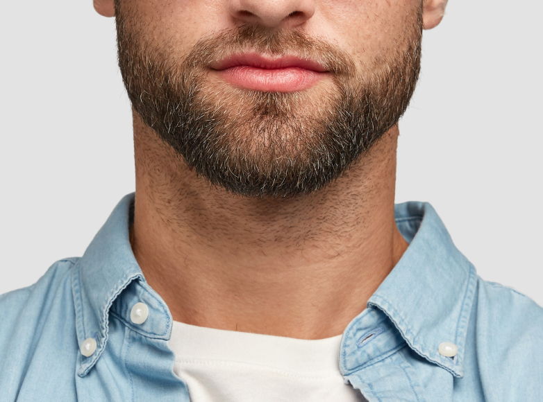 Пересадка Волос в Москве Цена Фикс. 70-147 тыс.руб. Без боли. За 1 день ...