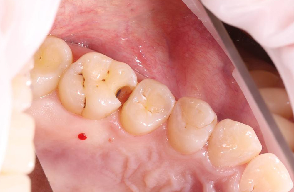 Реставрация сколотого зуба методом послойного нанесения пломбы