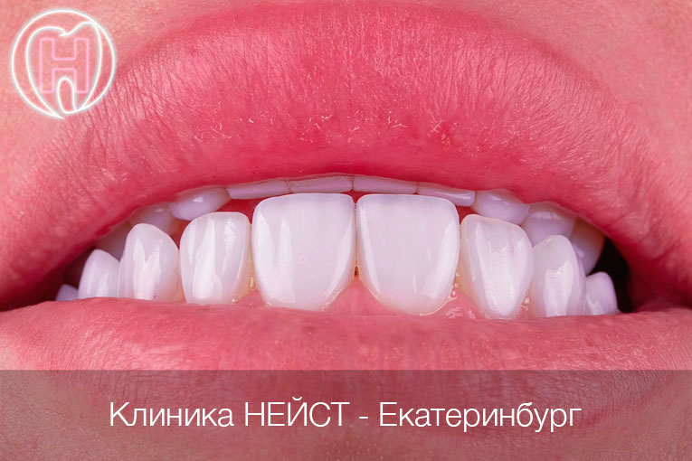 композитные виниры Премиум в Екатеринбурге, цвет Блич 2