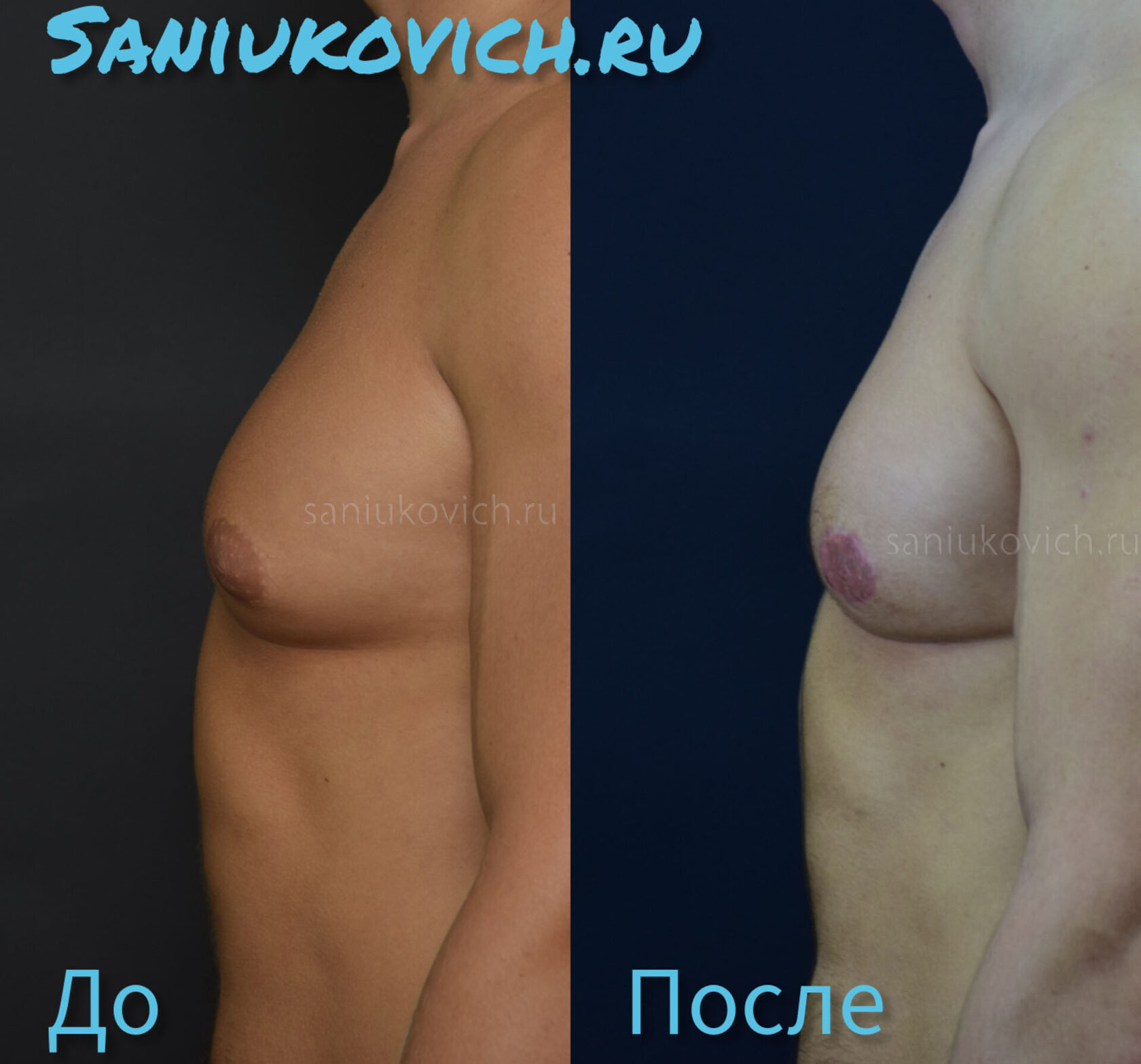 как проходит операция по уменьшению груди у женщин фото 119