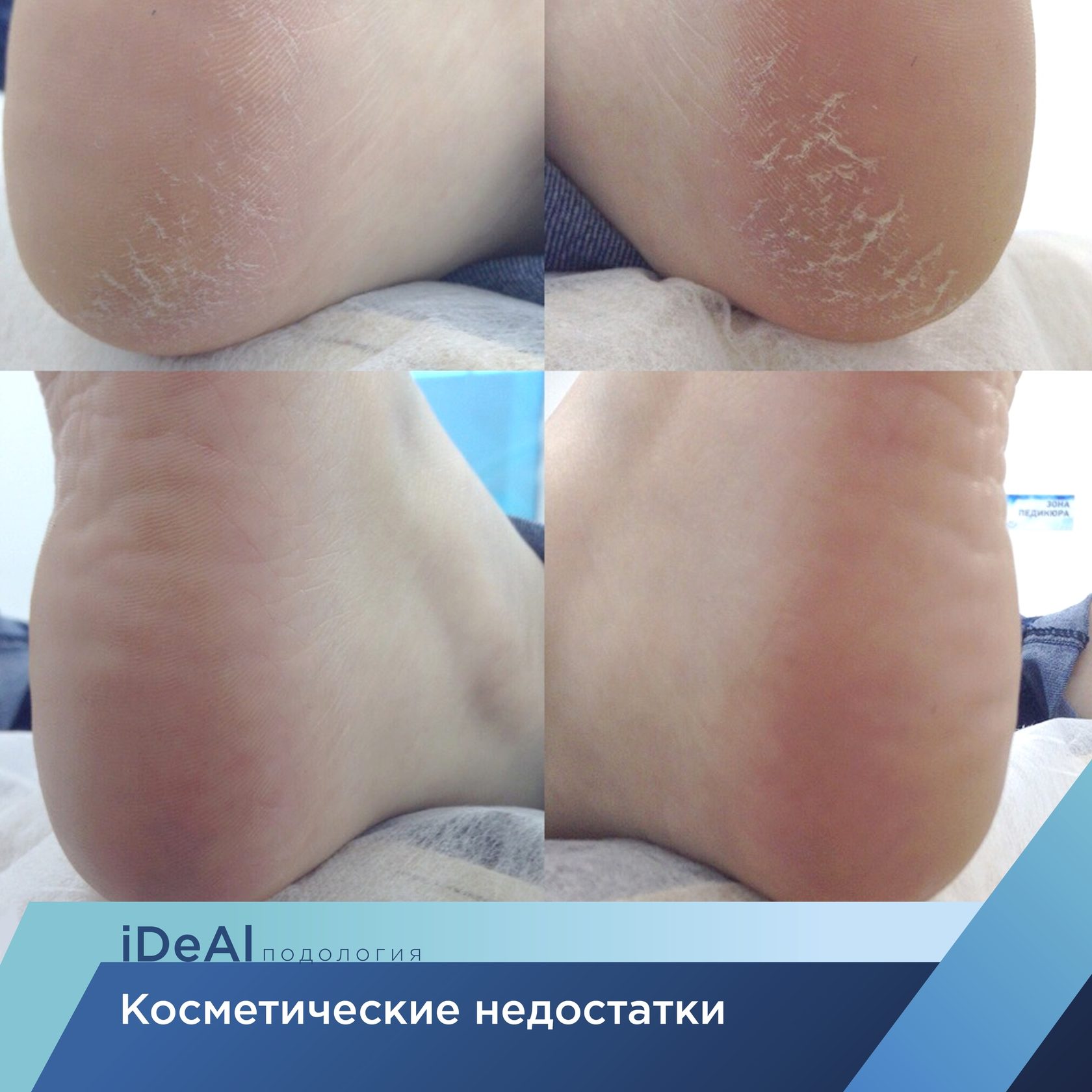 Удаление трещин на стопах в Курске