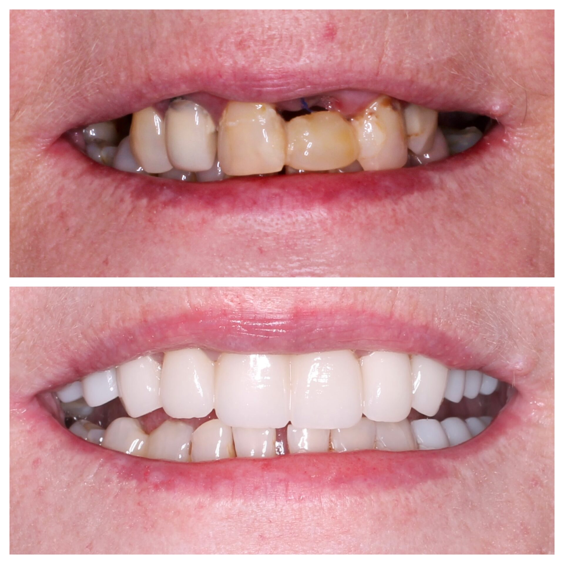 коронки на имплантате,коронка на зуб,стоматология чебоксары,стоматология Йошкар-ола,имплантация зубов чебоксары