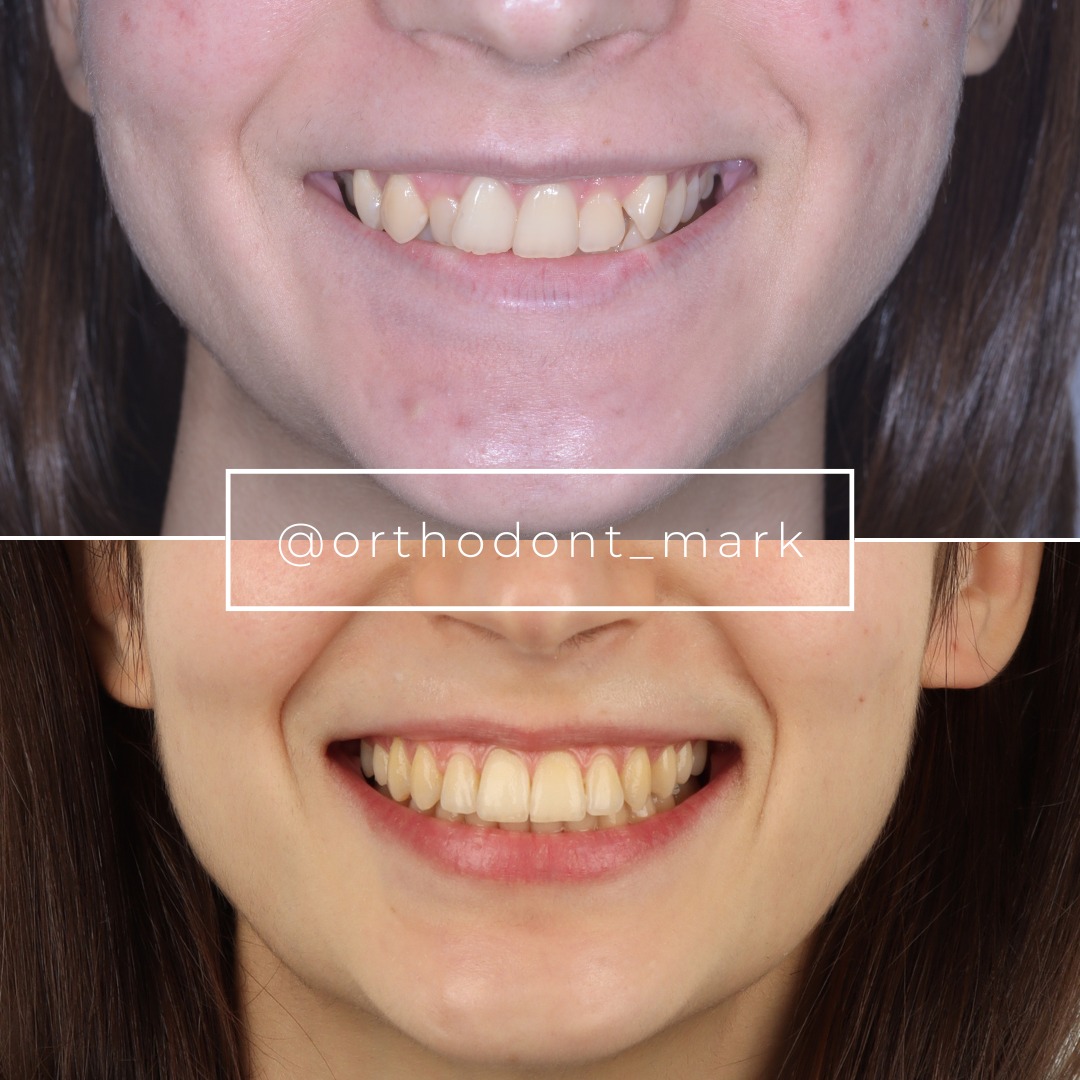 Severe Crowding and Scissor Bite Resolved Without Extraction