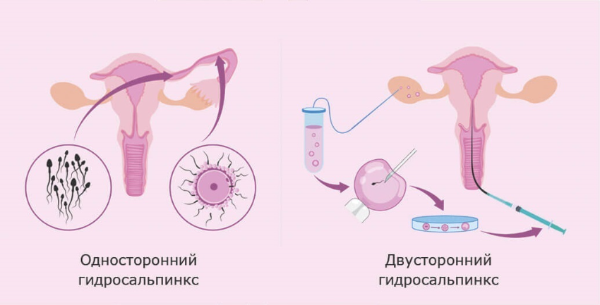 Гидросальпинкс: симптомы, причины, диагностика, лечение гидросальпинкса в Москве