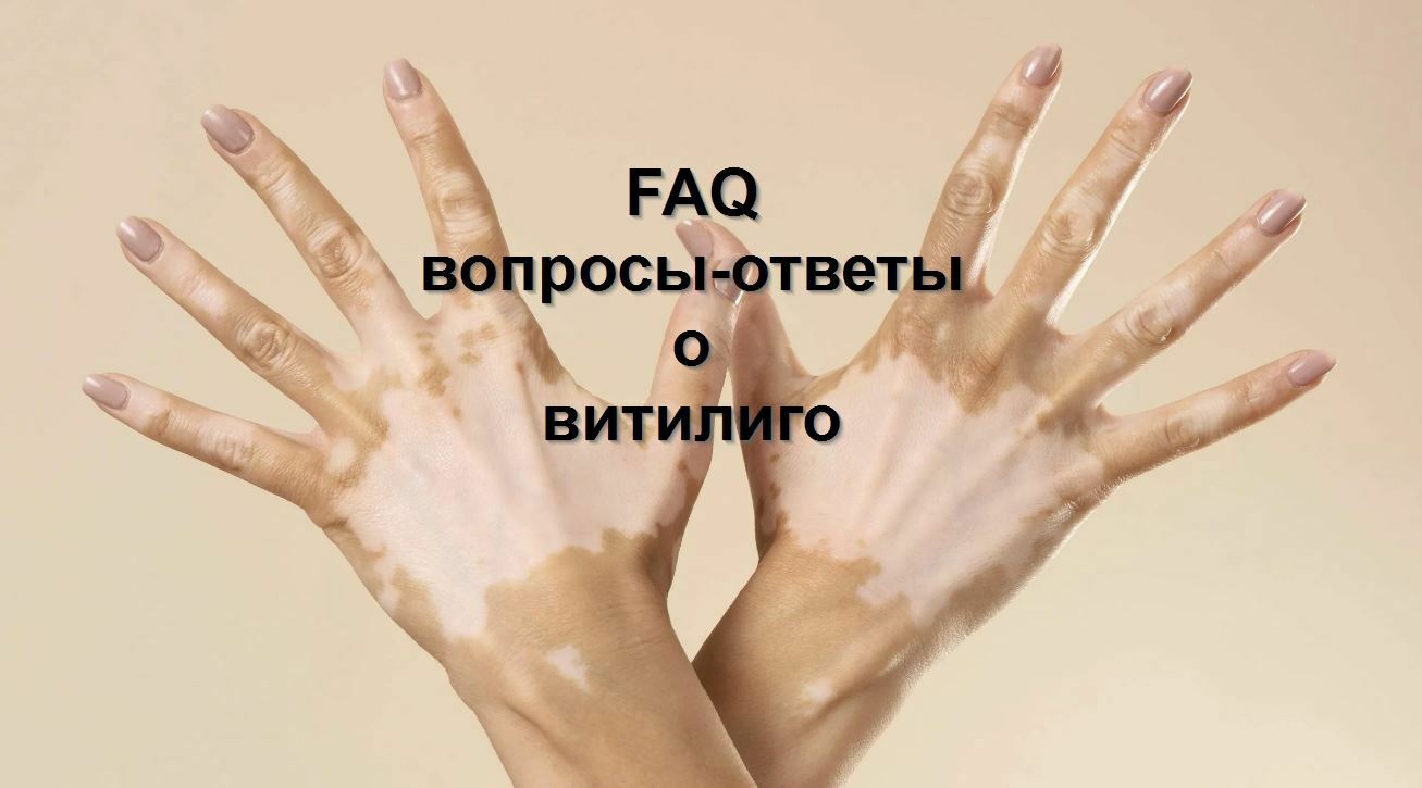 FAQ о витилиго, вопросы и ответы