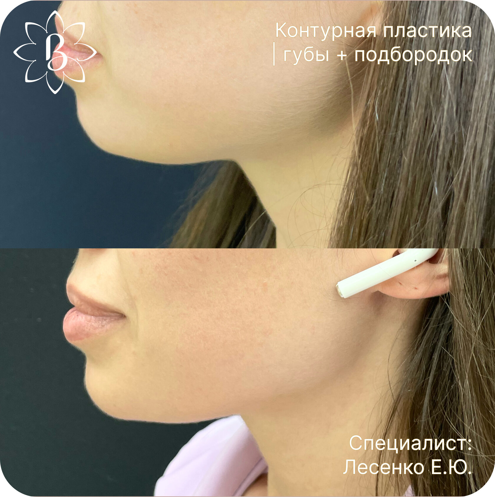 Александритовая лазерная эпиляция СПб