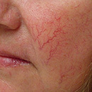 rf-лифтинг гипергидроз