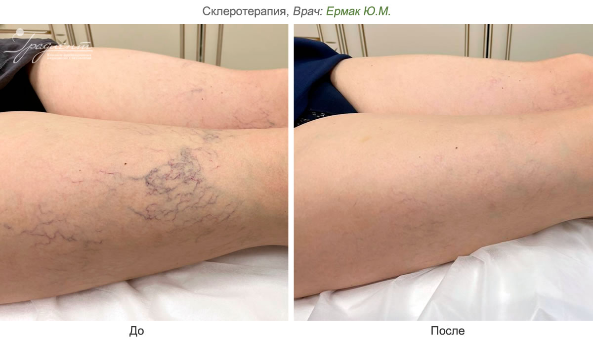 Склеротерапия вен – процедура, признанная во всем мире, как золотой  стандарт.