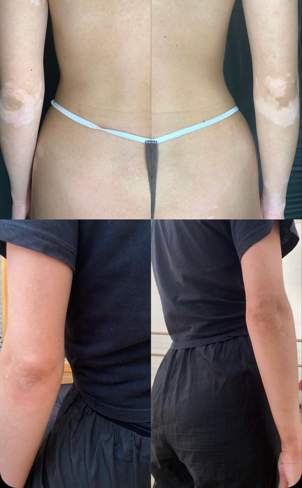 Витилиго и моментальный загар