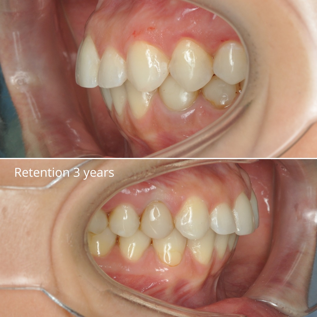 After treatment: even, symmetric smile arc with corrected occlusal plane — photo 5 of 5