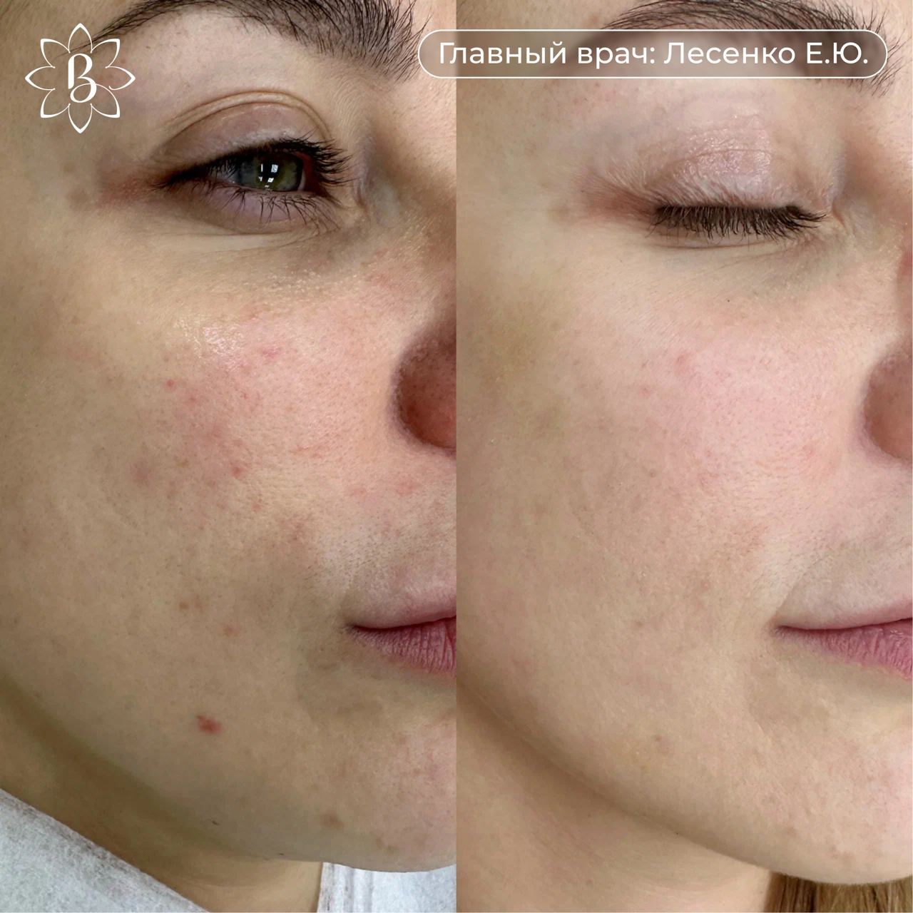 Биоревитализация препаратом Revi Silk