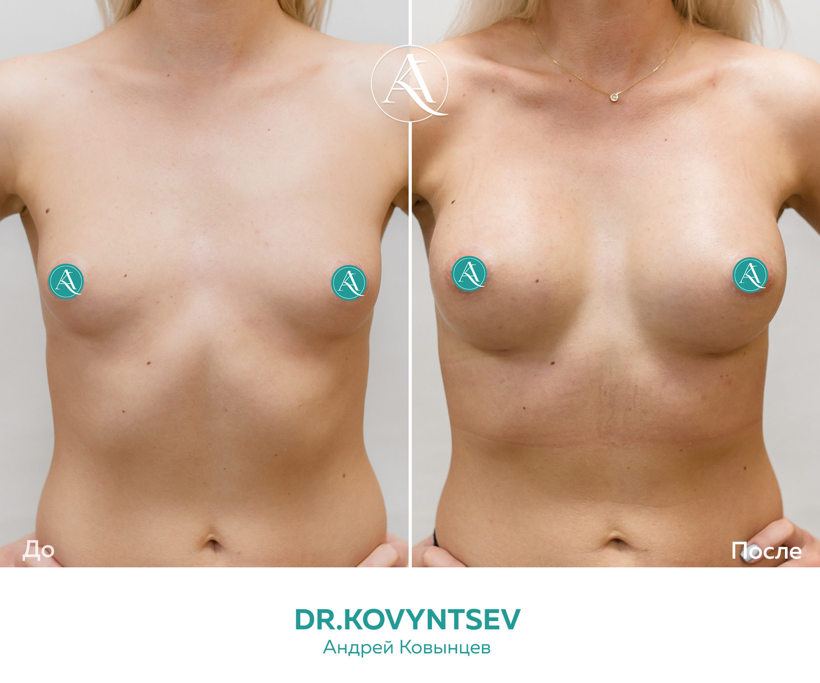 гормоны отвечающие за рост груди у женщин фото 110