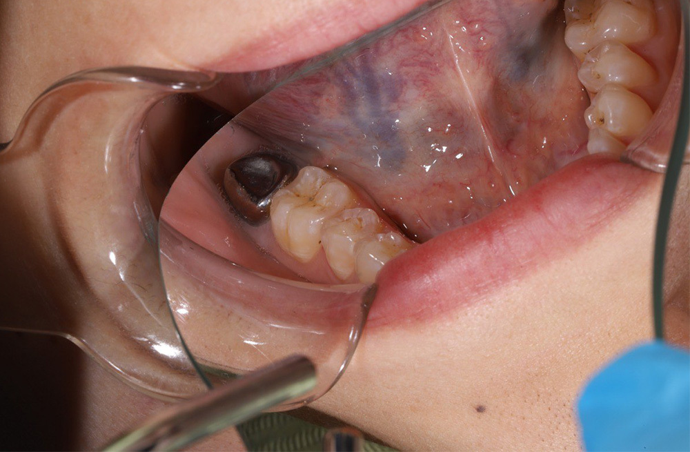 Восстановление разрушенного зуба с помощью одномоментной имплантации и циркониевой коронки