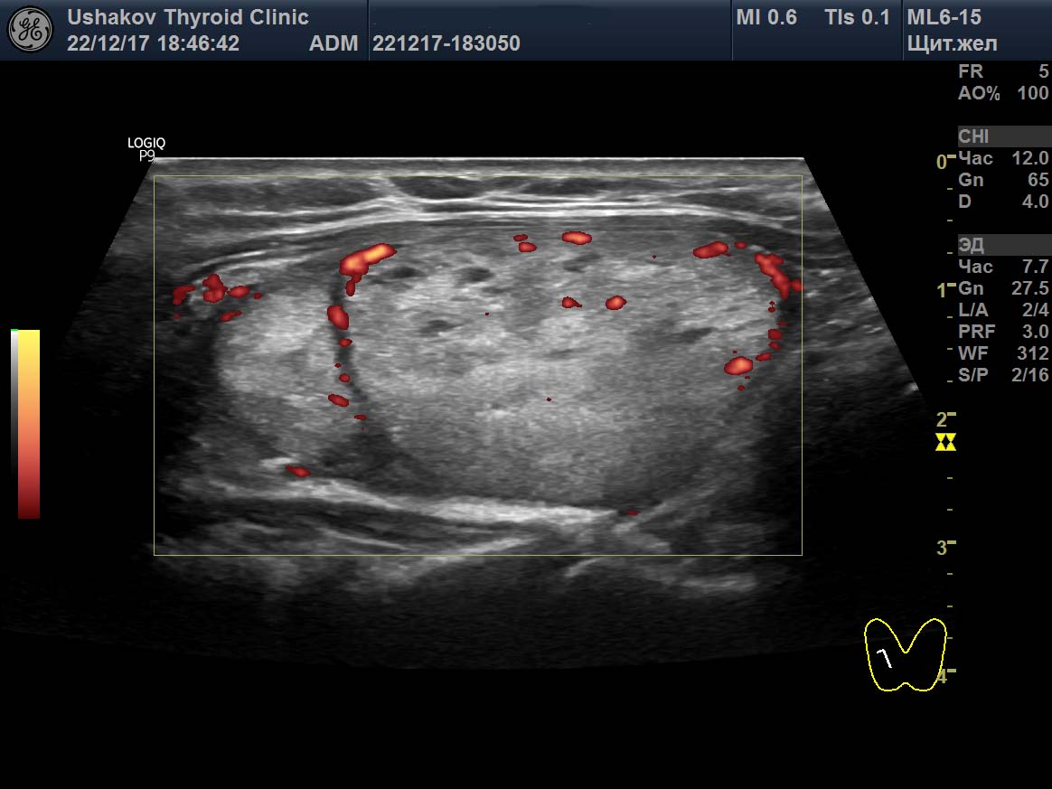 Узел щитовидной железы ti rads 3