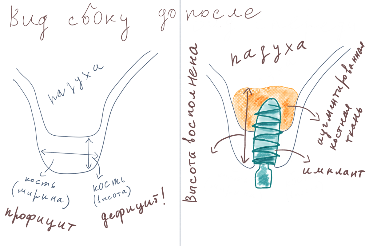 Синус лифтинг схема