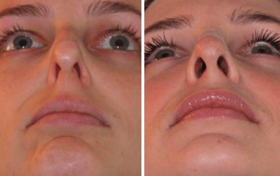 Можно ли исправить искривление носовой перегородки с помощью пластики?