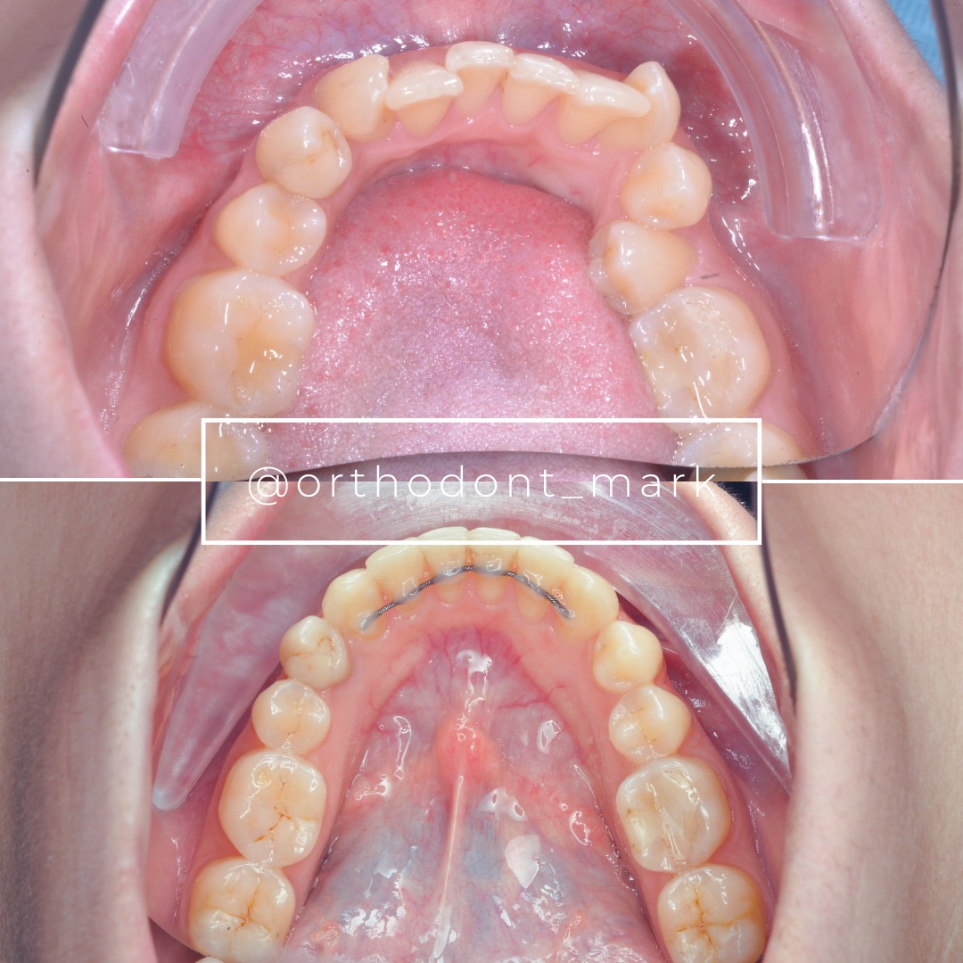 After treatment: aesthetic, balanced, and stable non-extraction result — photo 6 of 6