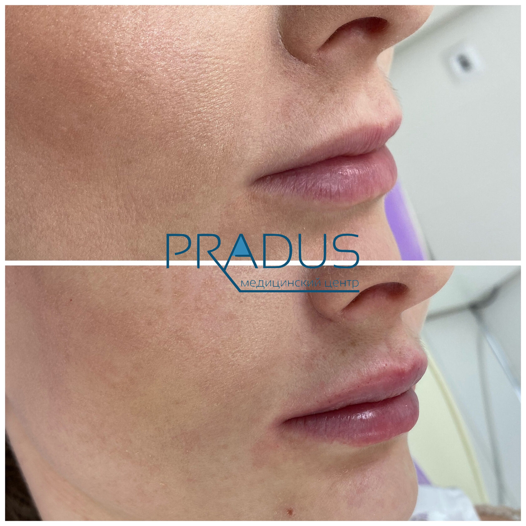 До и после контурной пластики губ. Увеличение объёма без утяжеления. PradusCOSMO, Васильевский остров