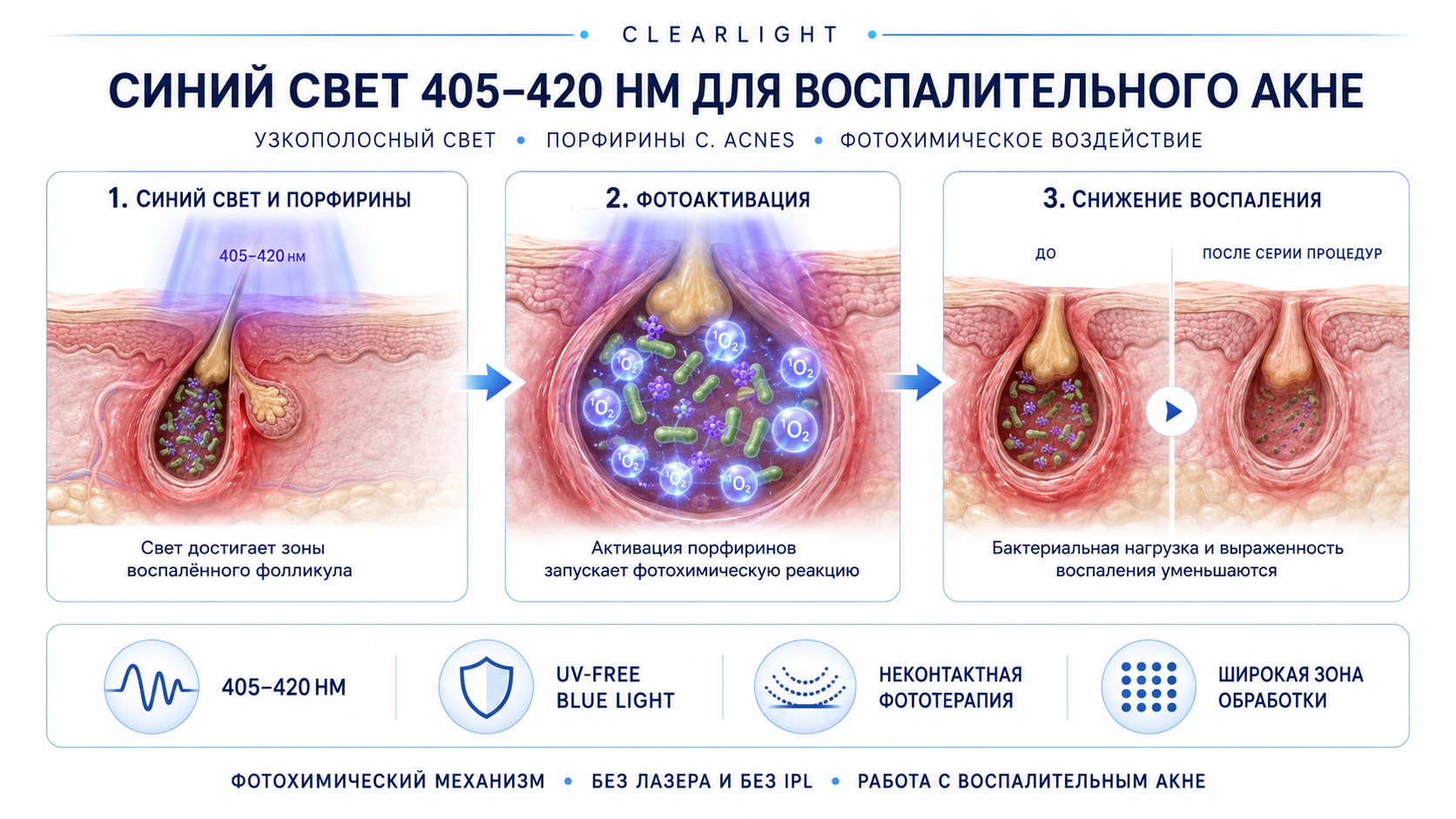 ClearLight 430 нм: схема фотохимического воздействия при воспалительном акне