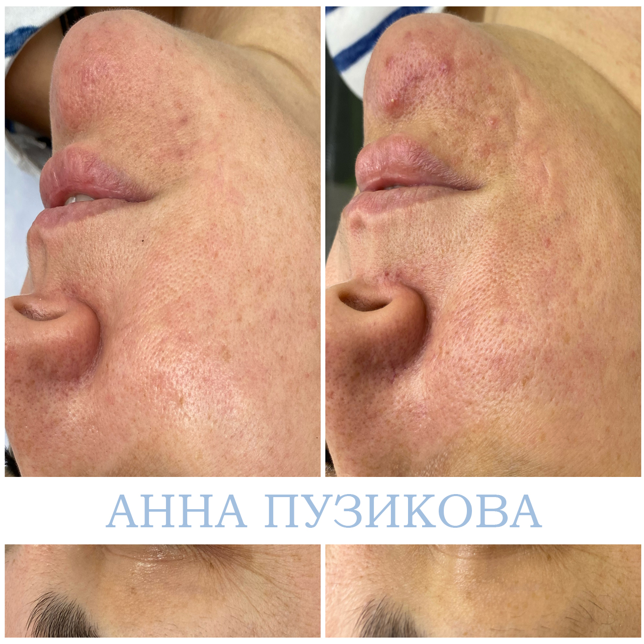 Результат удаления шрама у пациента — косметолог Пузикова Анна Анатольевна, Санкт-Петербург