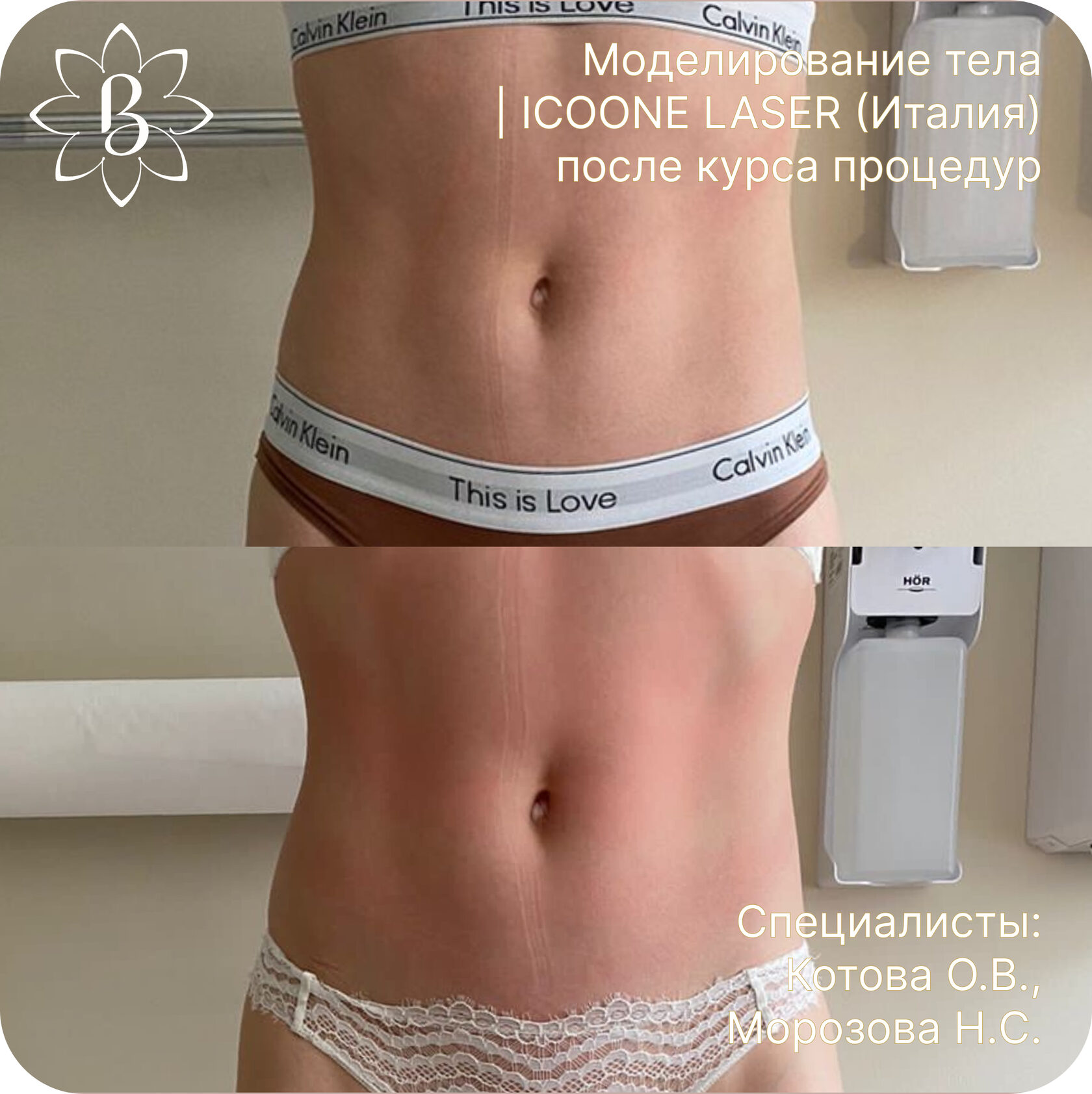 Диодная лазерная эпиляция