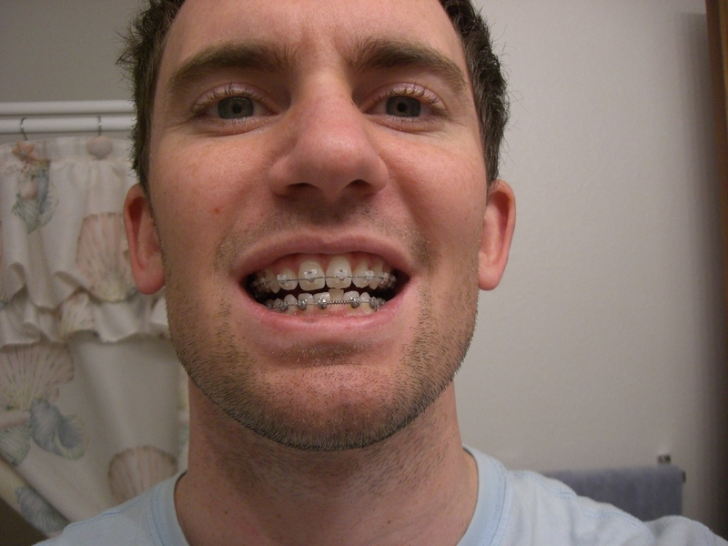 Брекеты на зубах фото у мужчин