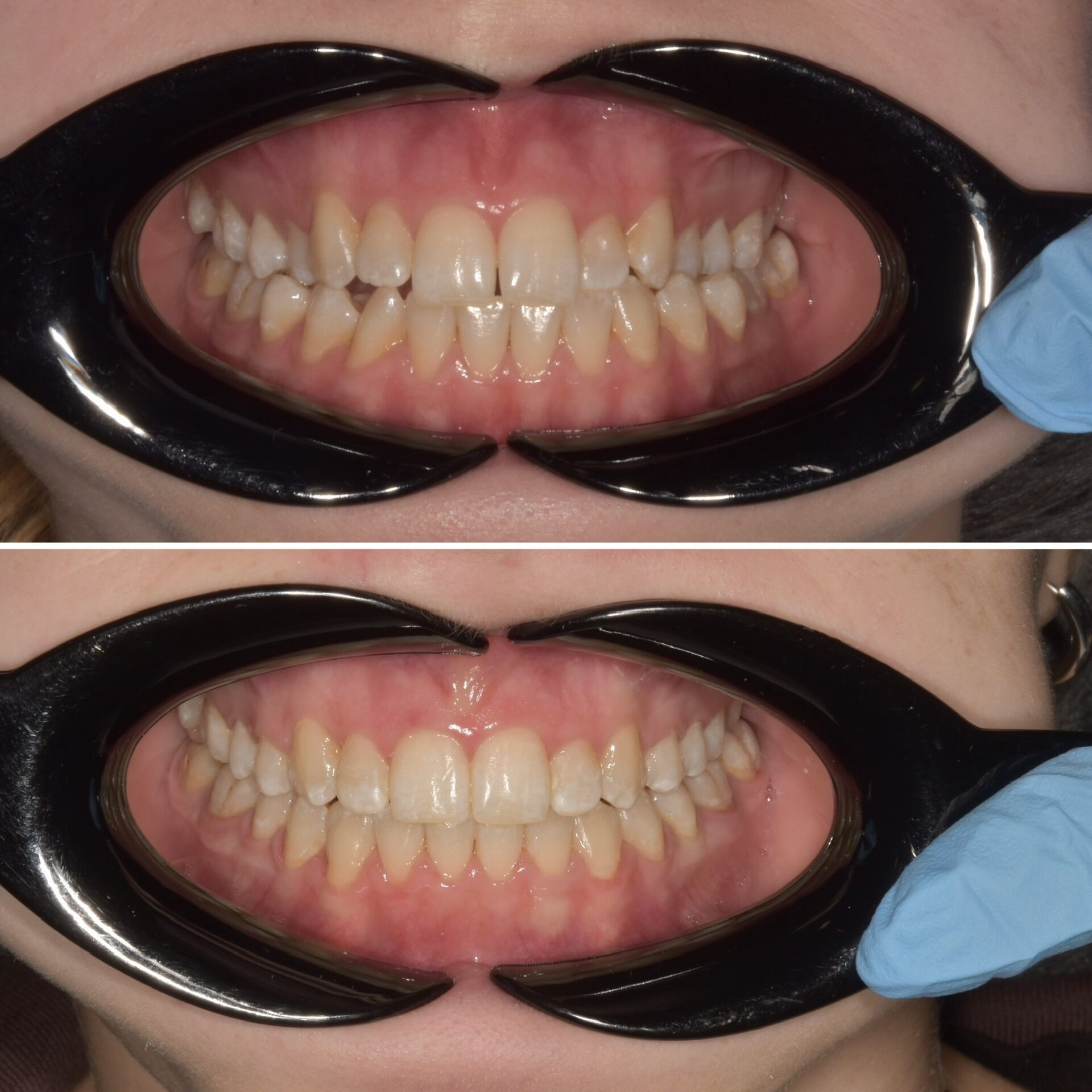 исправление прикуса на брекетах,выравнивание зубов на брекетах в чебоксарах, брекеты чебоксары,брекеты йошкар-ола