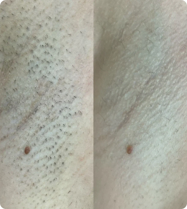 лазерная эпиляция