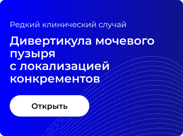 ДИВЕРТИКУЛА МОЧЕВОГО ПУЗЫРЯ С ЛОКАЛИЗАЦИЕЙ КОНКРЕМЕНТОВ