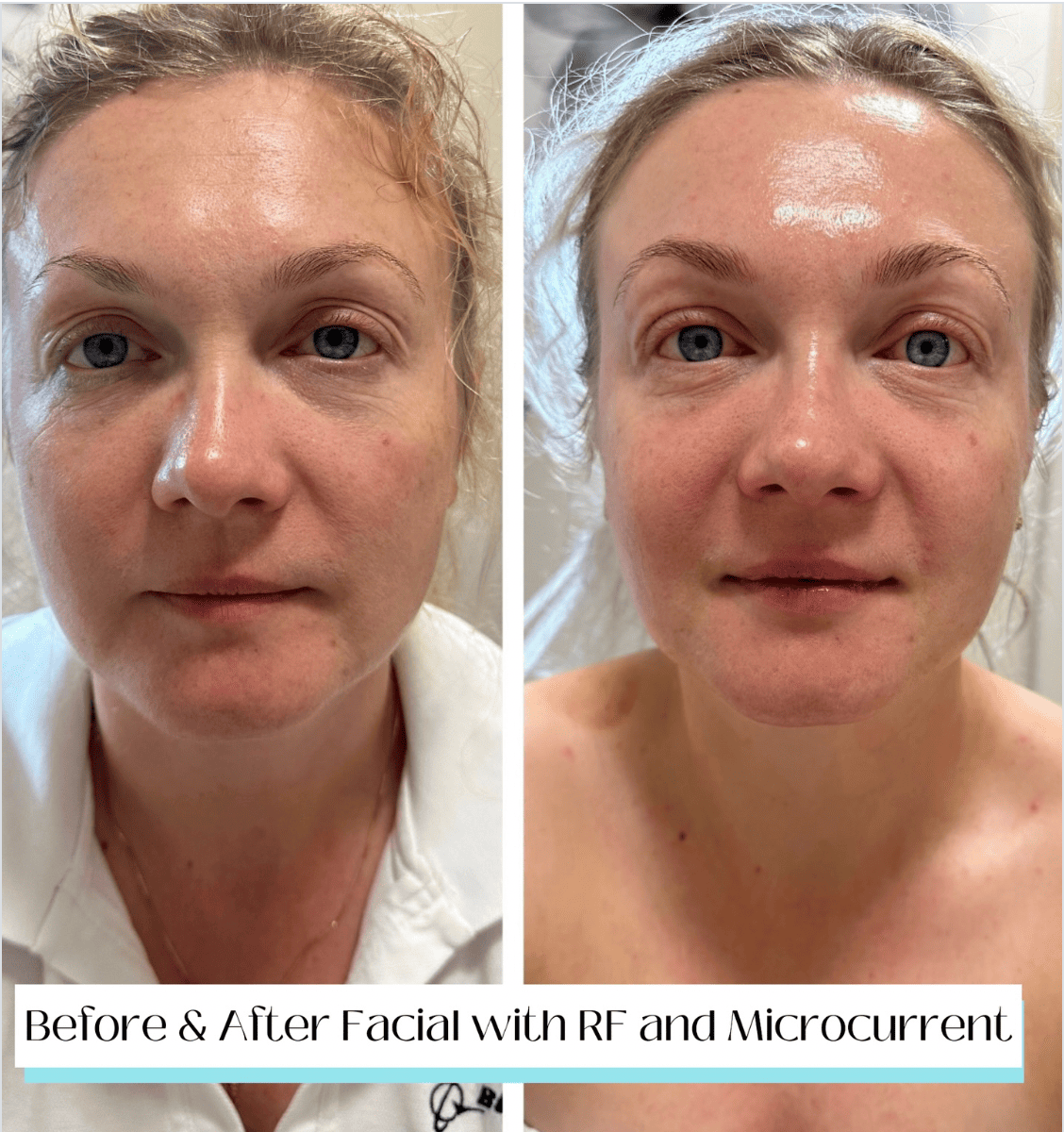RF Microcurrent facial results before after skin firming Beauty Studio by Hanna Mount Pleasant SC