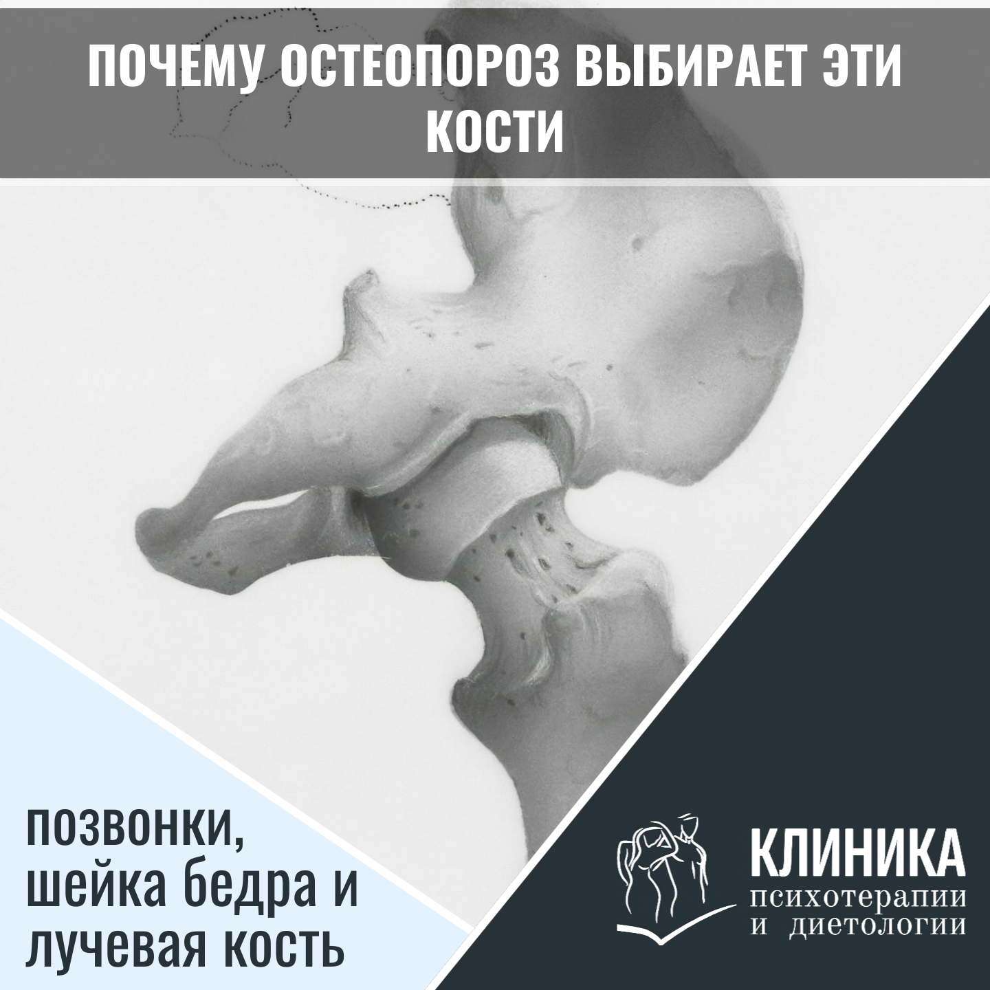Почему остеопороз выбирает эти кости: позвонки, шейка бедра и лучевая кость