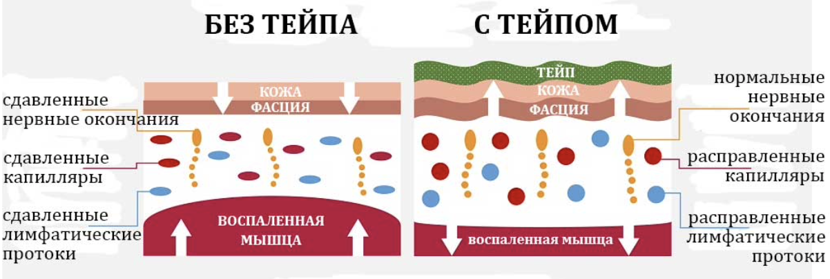 Как работают тейпы. Принцип действия тейпов. Механизм действия тейпов. Принцип действия кинезиотейпа. Принцип действия тейпа кожа.