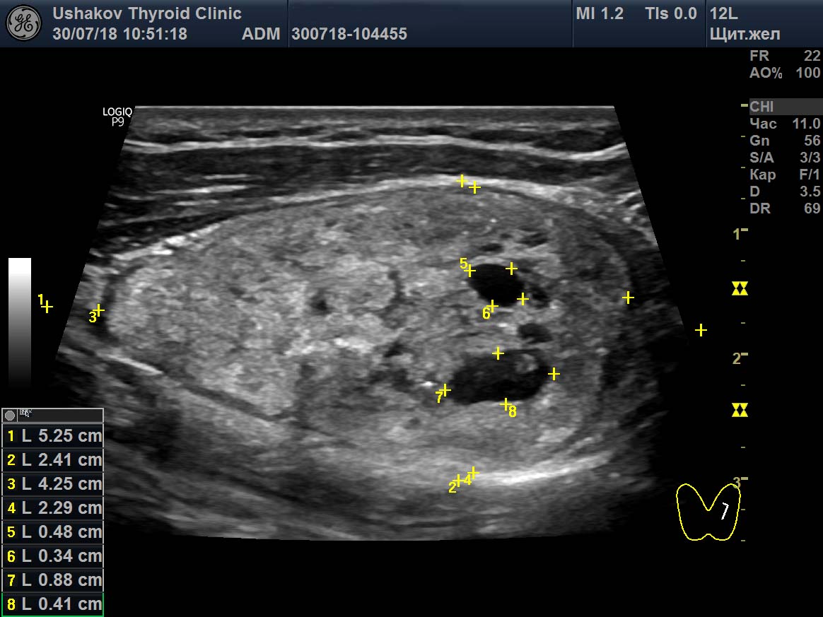 Клинический «ПРОТОКОЛ УЗИ ЩЖ» №8