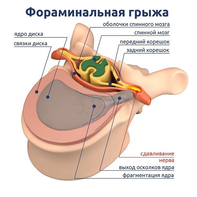 Виды межпозвонковых грыж